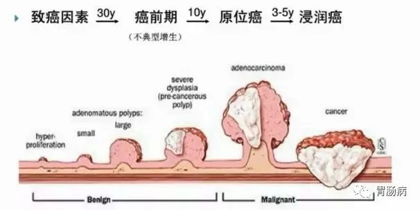 體檢查出腸息肉一定要切除！ 95%腸癌由它演變而來